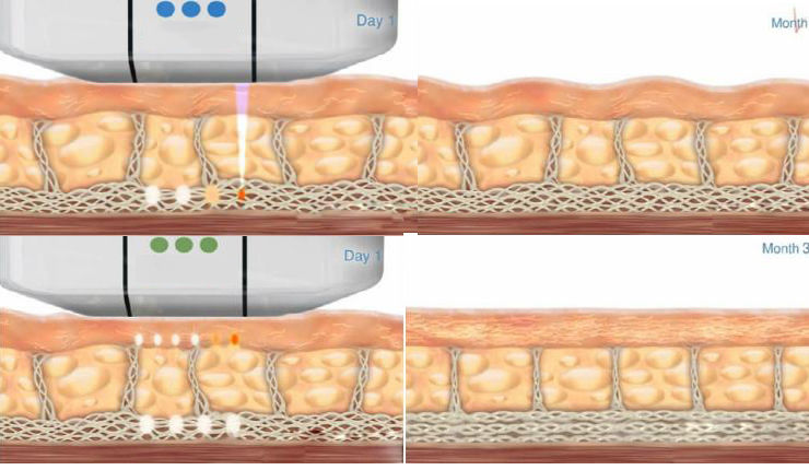 Wrinkle Removal High Intensity Focused Ultrasound Hifu Machine Facial Skin Care DIAGNOSTIC ULTRASOUND MACHINES FOR SALE