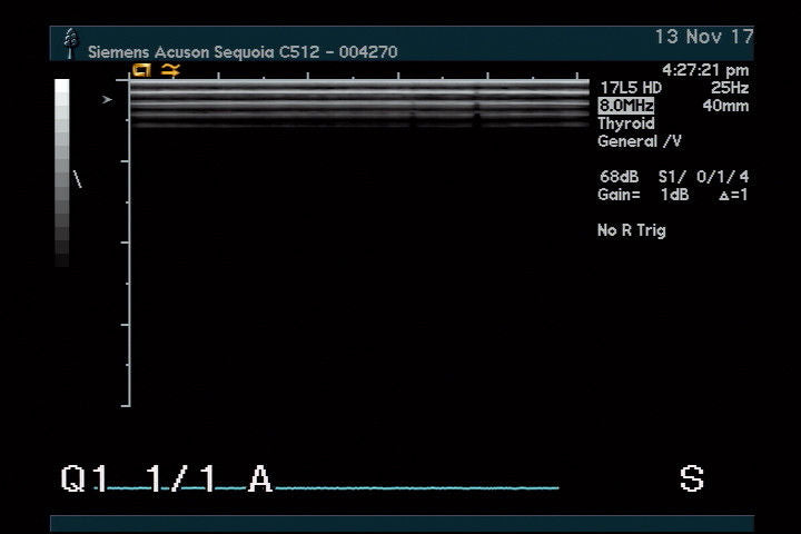 Acuson 17L5 HD Ultrasound Probe - New Lower Price! DIAGNOSTIC ULTRASOUND MACHINES FOR SALE