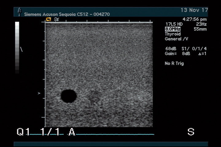 Acuson 17L5 HD Ultrasound Probe - New Lower Price! DIAGNOSTIC ULTRASOUND MACHINES FOR SALE