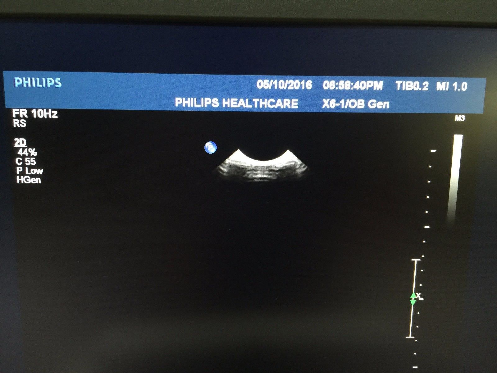 ultrasound monitor screen