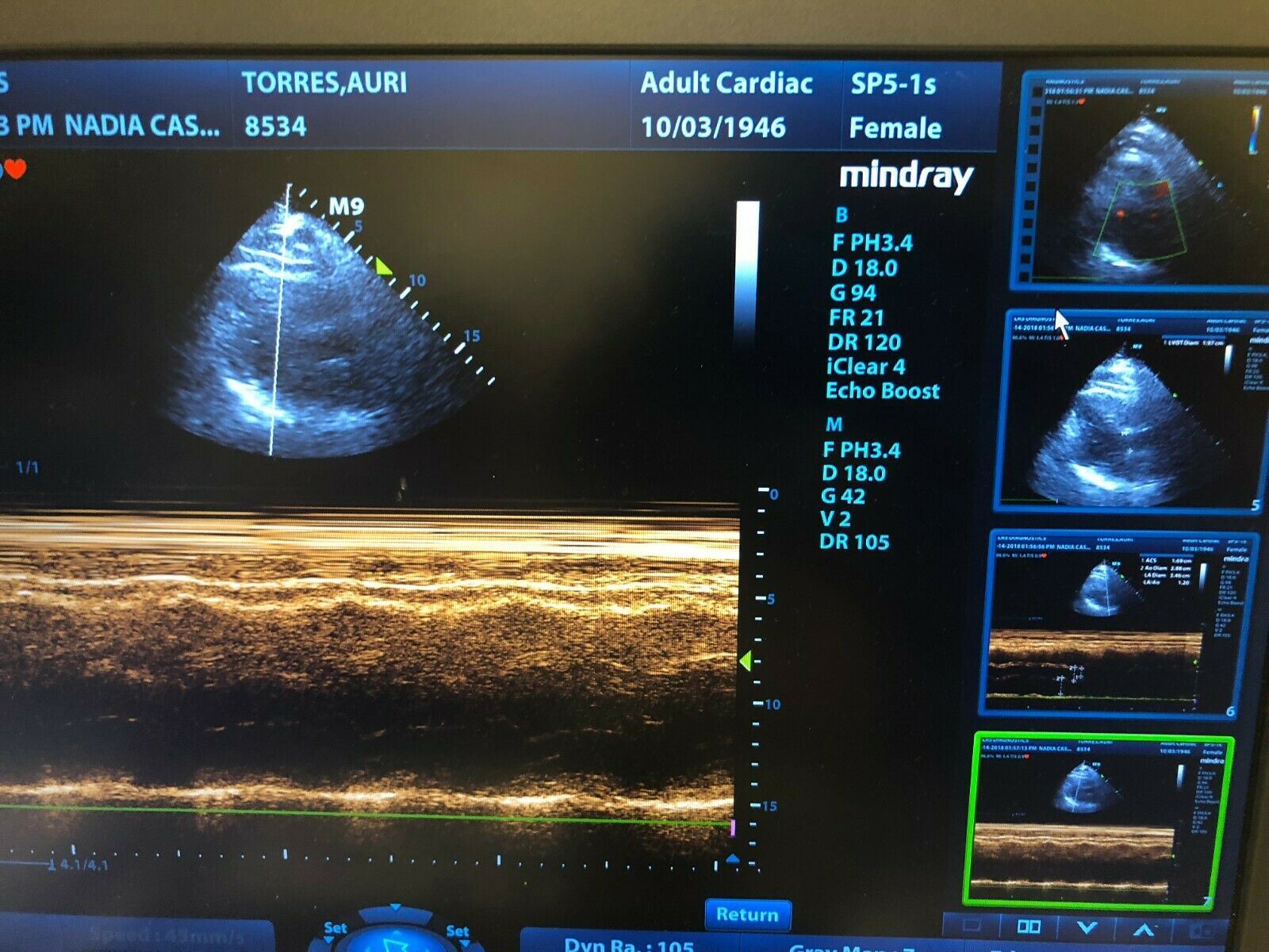 Mindray M9 Portable Ultrasound With  Two Probes (L12-4S) (C5-1S) DOM 2015 DIAGNOSTIC ULTRASOUND MACHINES FOR SALE