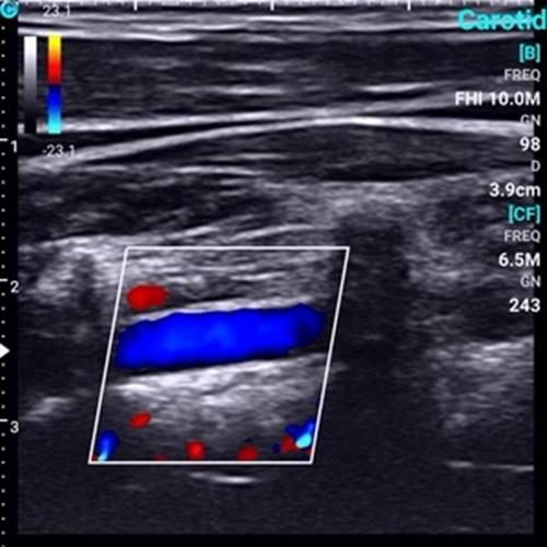 Supper Small Chison SonoEye  P1 Linear Array for android Color Doppler Vascular DIAGNOSTIC ULTRASOUND MACHINES FOR SALE