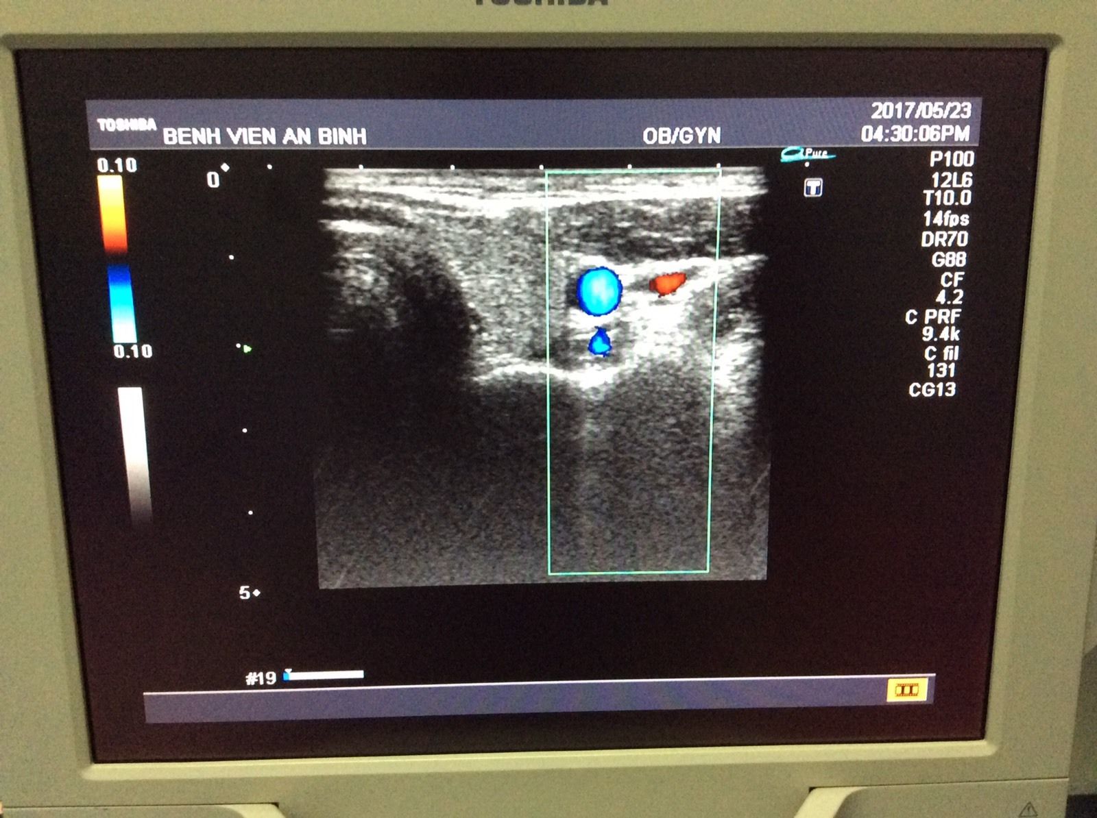 Toshiba Ultrasound transducer probe linear PLM-805AT DIAGNOSTIC ULTRASOUND MACHINES FOR SALE