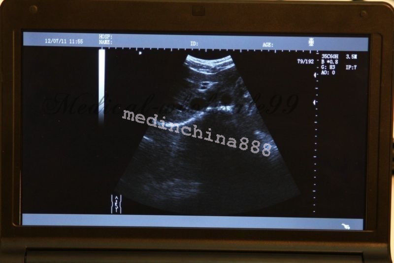 Laptop Ultrasound Scanner +Convex+Linear+Transvaginal 3 Probes Monitor Machine 190891247346 DIAGNOSTIC ULTRASOUND MACHINES FOR SALE