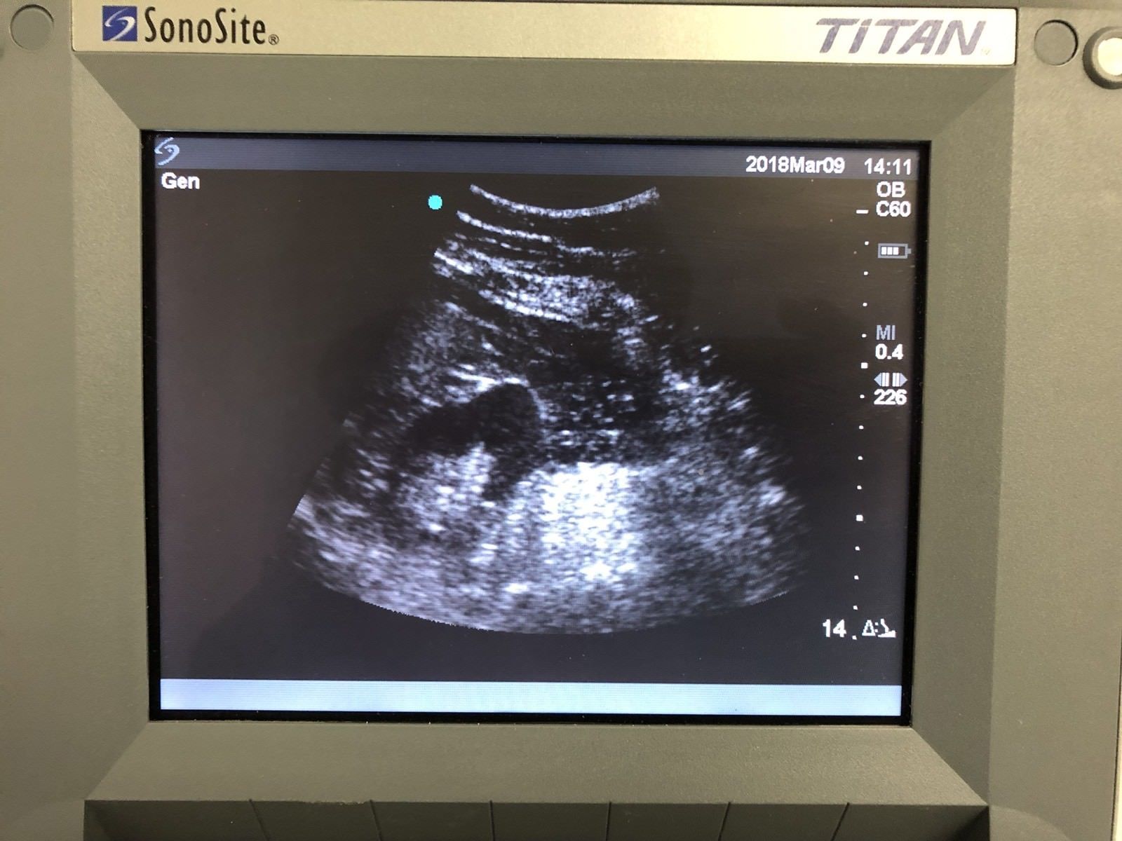 SONOSITE TITAN Ultrasound With C60/5-2 Convex Array Probe And Power Supply DIAGNOSTIC ULTRASOUND MACHINES FOR SALE