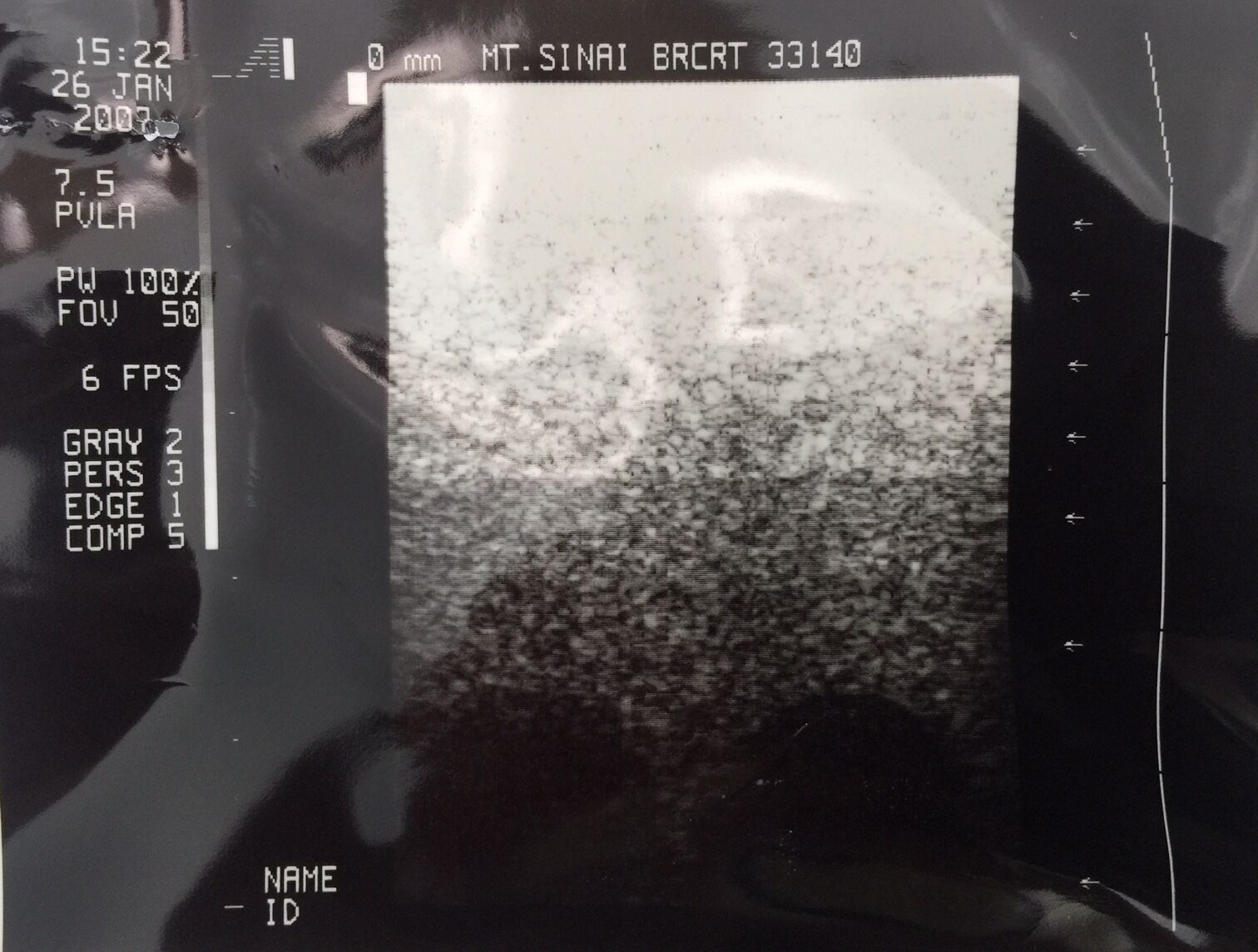 ACOUSTIC IMAGING PVLA 7.5 MHz. ULTRASOUND TRANSDUCER PROBE Used ~ full-tested DIAGNOSTIC ULTRASOUND MACHINES FOR SALE