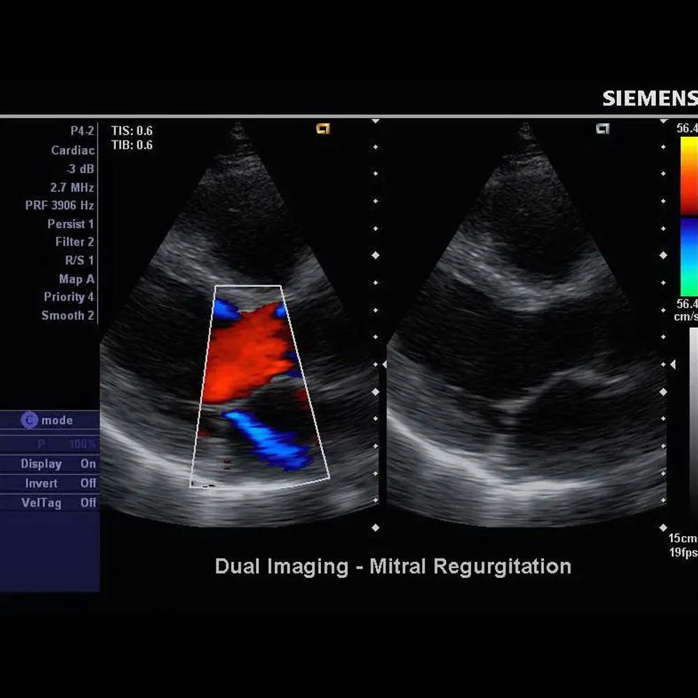 Siemens Acuson Ultrasound System - X150 Scan Machine with Color Dopp & Box Only DIAGNOSTIC ULTRASOUND MACHINES FOR SALE