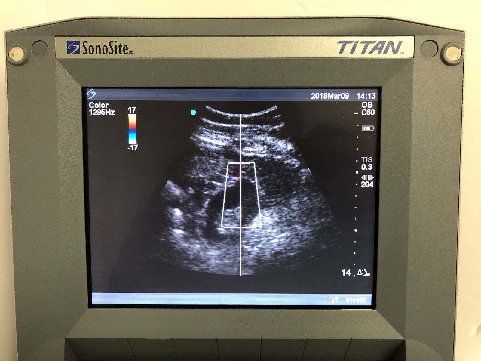 SONOSITE TITAN Ultrasound With C60/5-2 Convex Array Probe And Power Supply DIAGNOSTIC ULTRASOUND MACHINES FOR SALE