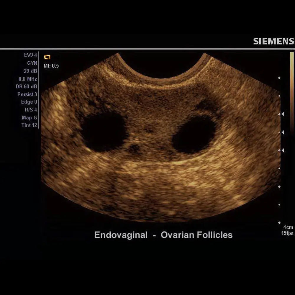 Siemens Acuson Ultrasound System - X150 Scan Machine with Color Dopp & Box Only DIAGNOSTIC ULTRASOUND MACHINES FOR SALE