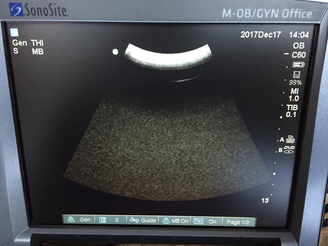 SonoSite M Turbo Ultrasound with C60X Curved Abdominal, ICTx Transvaginal Probes DIAGNOSTIC ULTRASOUND MACHINES FOR SALE