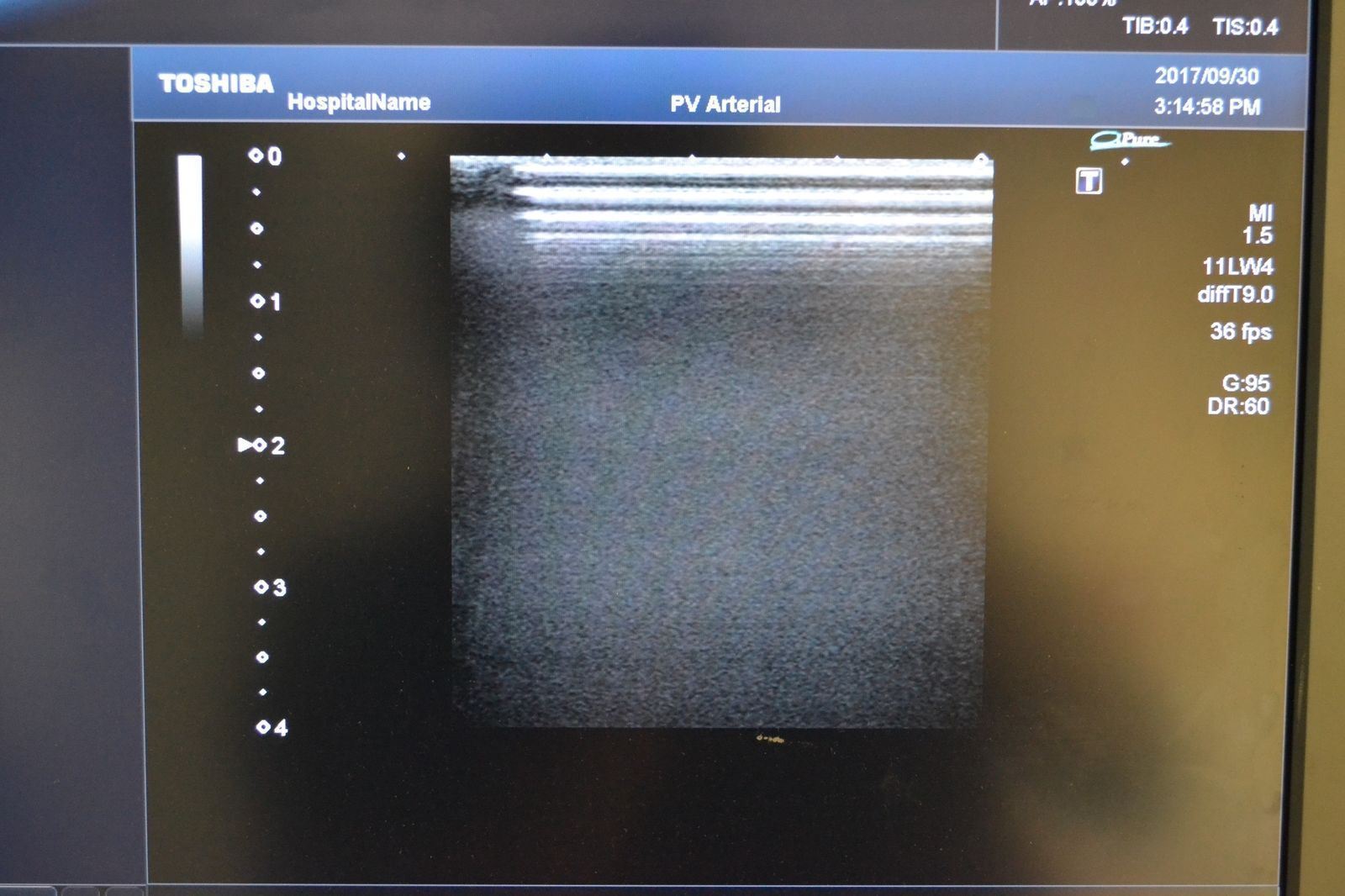 Toshiba Artida PLT-704SBT 11-4.8MHz Linear Ultrasound Transducer Probe  J1624 DIAGNOSTIC ULTRASOUND MACHINES FOR SALE