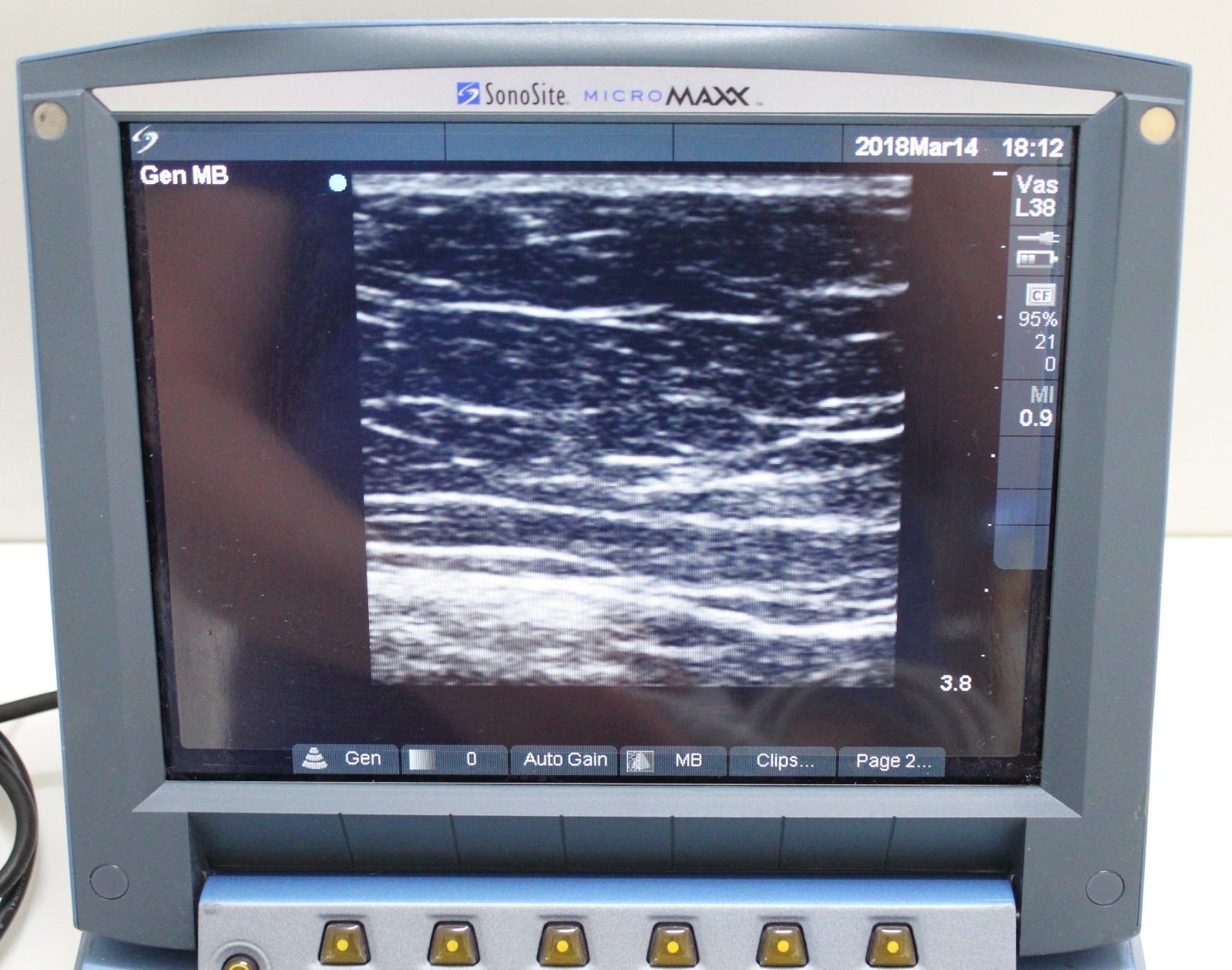 Sonosite Micromaxx Ultrasound ( please read) DIAGNOSTIC ULTRASOUND MACHINES FOR SALE