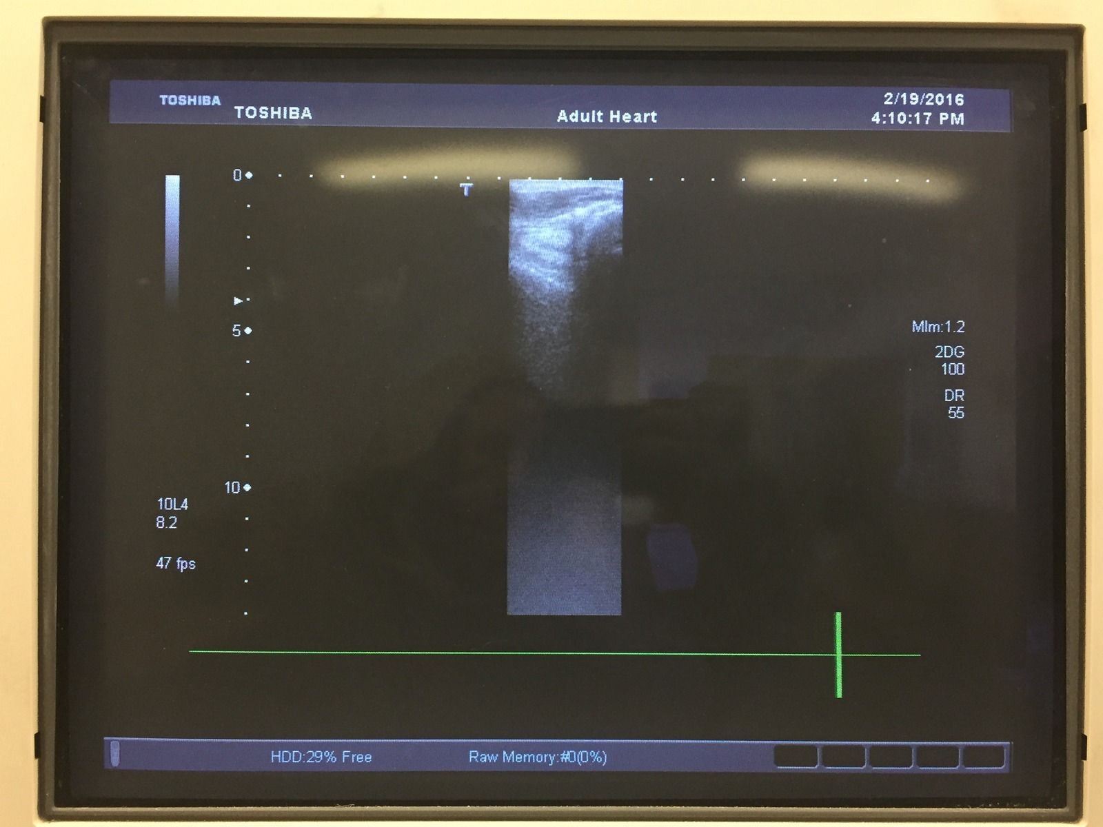 Toshiba Linear 6.0MHz PLT-604AT Ultrasound Transducer for Peripheral Vascular DIAGNOSTIC ULTRASOUND MACHINES FOR SALE