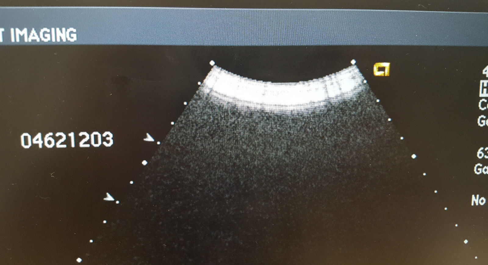 Acuson Siemens 4C1 Convex Abdominal Ultrasound Transducer Probe 08259644 Sequoia DIAGNOSTIC ULTRASOUND MACHINES FOR SALE