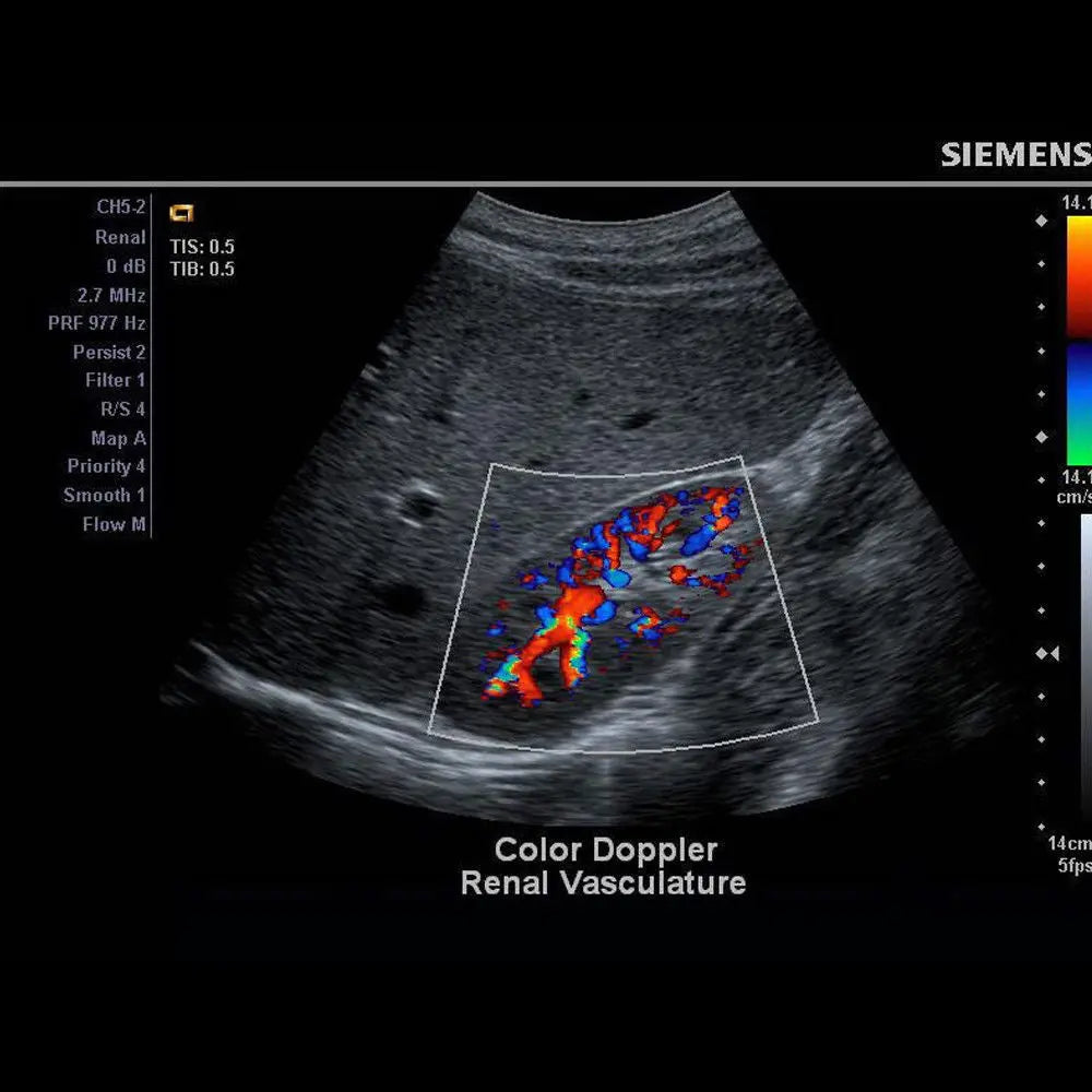 Siemens Acuson Ultrasound System - X150 Scan Machine with Color Dopp & Box Only DIAGNOSTIC ULTRASOUND MACHINES FOR SALE