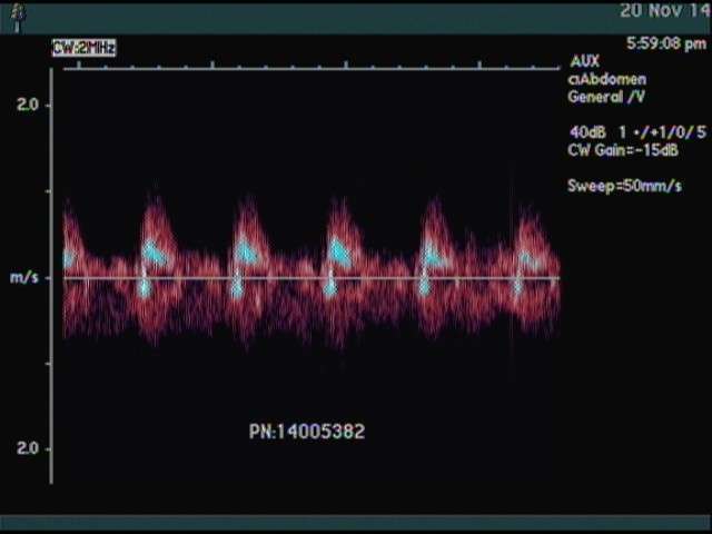 Acuson 2.0 CW Ultrasound Probe DIAGNOSTIC ULTRASOUND MACHINES FOR SALE