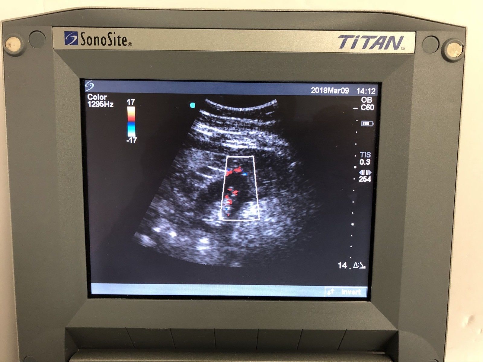 SONOSITE TITAN Ultrasound With C60/5-2 Convex Array Probe And Power Supply DIAGNOSTIC ULTRASOUND MACHINES FOR SALE